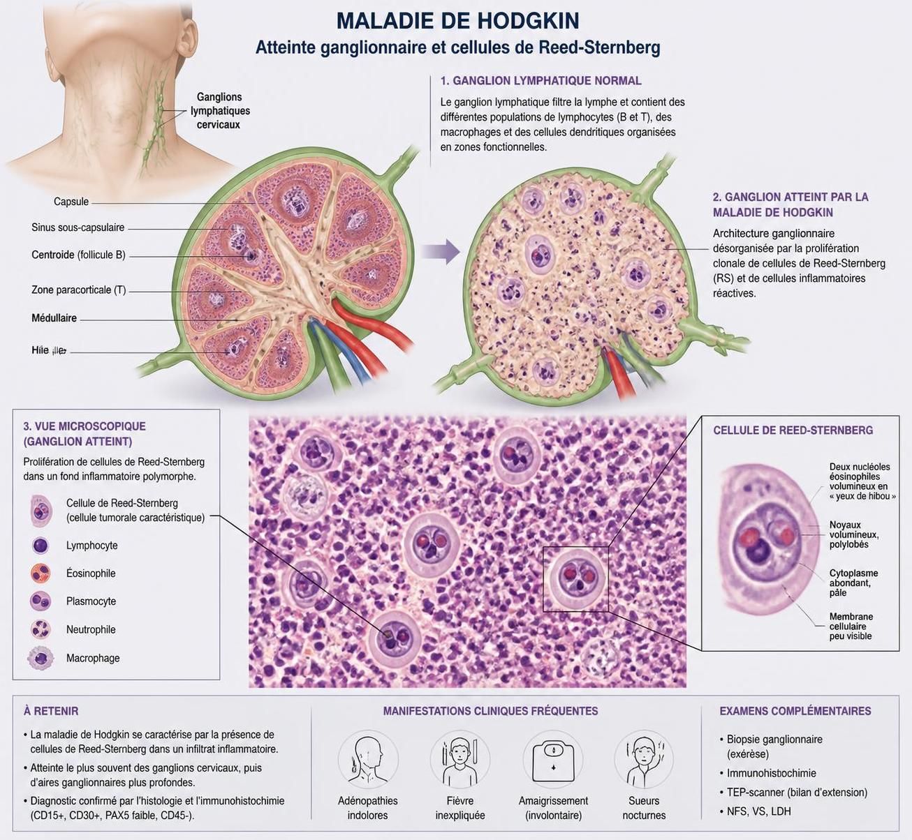 découvrez tout sur la maladie de hodgkin : symptômes, méthodes de diagnostic et options de traitement pour mieux comprendre cette pathologie.