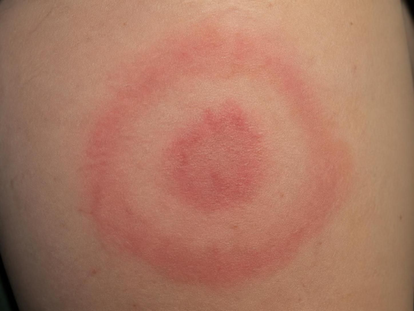 découvrez les principaux symptômes de la maladie de lyme, comment les identifier rapidement et les démarches à suivre pour agir efficacement et protéger votre santé.