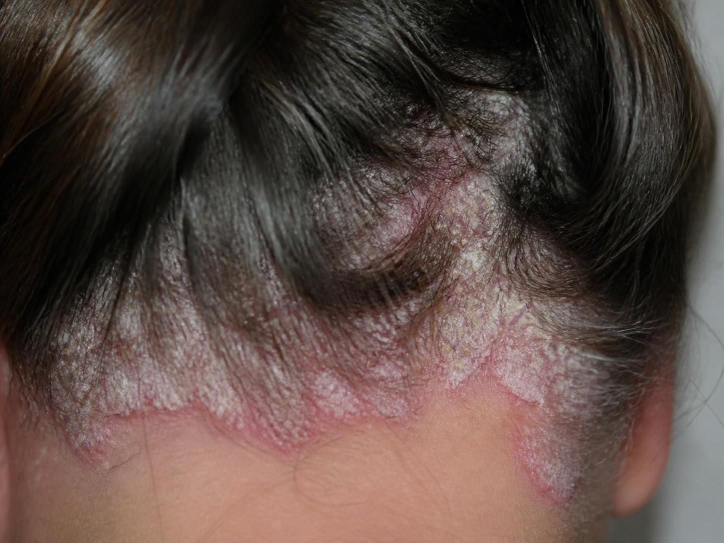 découvrez comment diagnostiquer les maladies du cuir chevelu grâce à des photos explicatives et profitez de conseils essentiels pour prendre soin de votre santé capillaire.