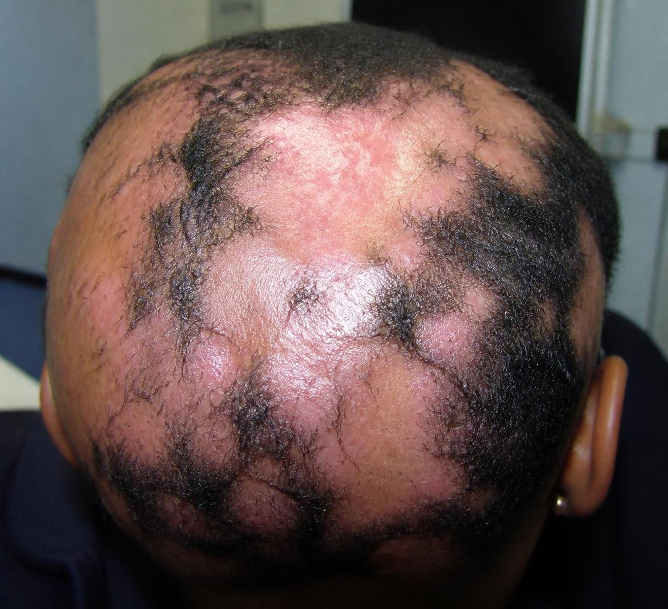 découvrez comment diagnostiquer les maladies du cuir chevelu grâce à une photo et bénéficiez de conseils essentiels pour un soin adapté et efficace.
