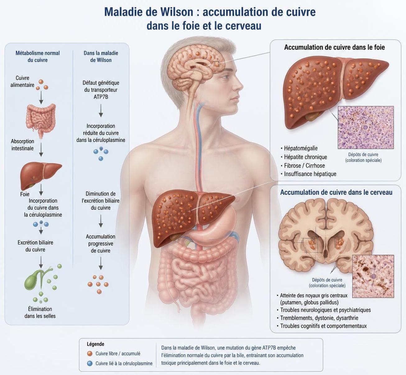découvrez tout sur la maladie de wilson en 2026 : symptômes, méthodes de diagnostic précises et options de traitement efficaces pour mieux vivre avec cette pathologie rare.